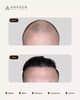 Slider image (8) Anagen - Hair Transplant Clinic in Switzerland